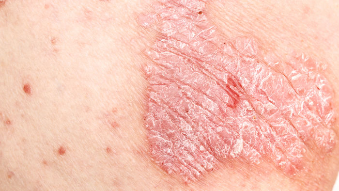 Psoriasis: Neue Einblicke in die Pathophysiologie