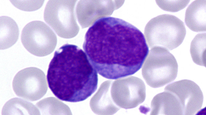 Genetische Studie erklärt Leukämie